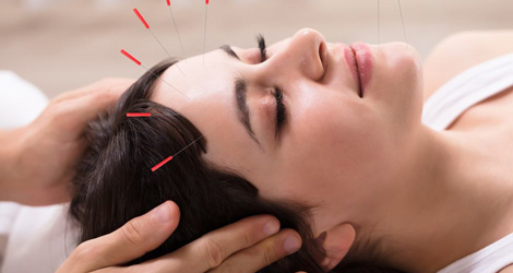 Acupuncture Treatment Brampton